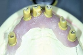 Primärteleskope in Wachs auf Implantaten